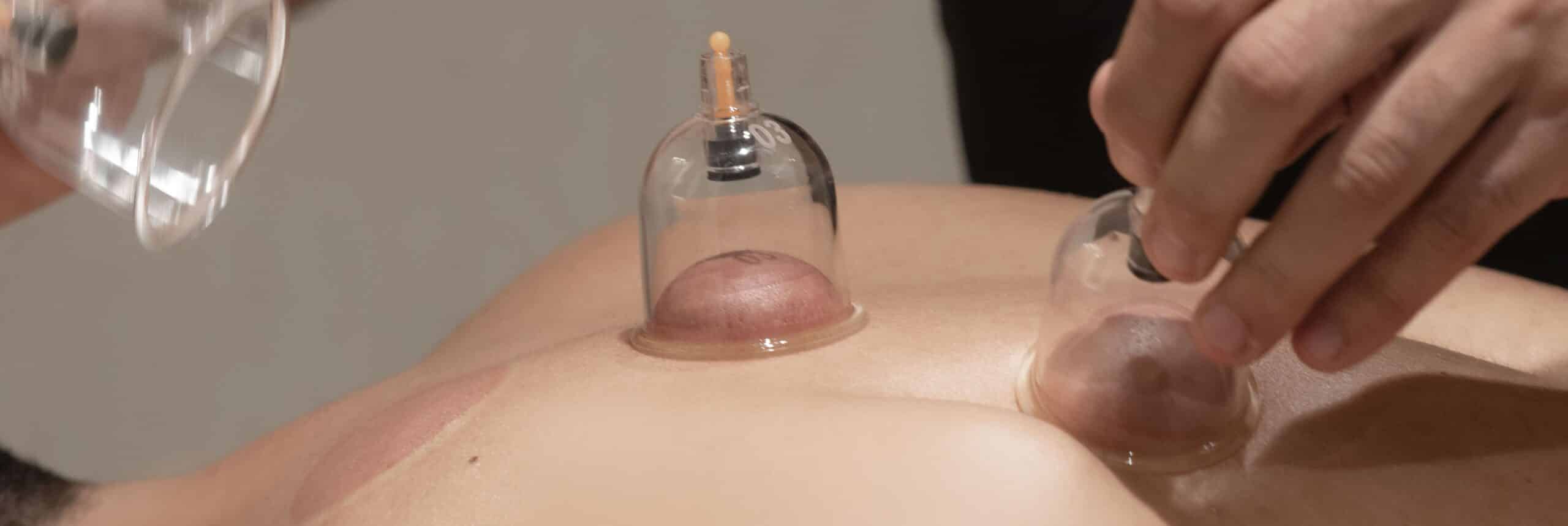 Best Cupping Therapy Dubai Fisio